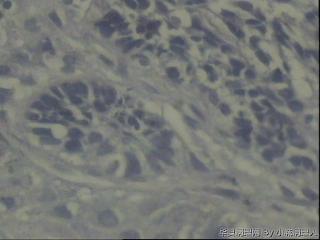 鼻背部肿物/皮脂腺癌？图13