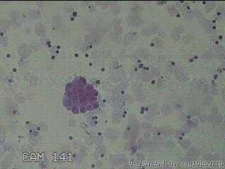 淡黄色胸水5ml图36