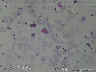 淡黄色胸水5ml图34