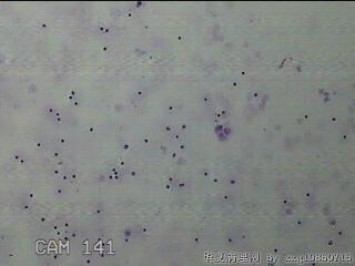 淡黄色胸水5ml图1