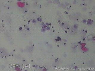 淡黄色胸水5ml图31