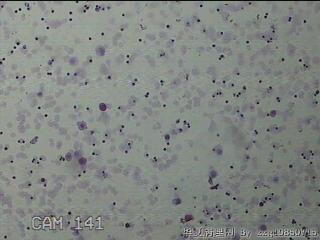 淡黄色胸水5ml图11