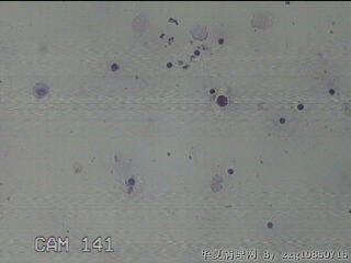 淡黄色胸水5ml图44