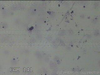 淡黄色胸水5ml图46