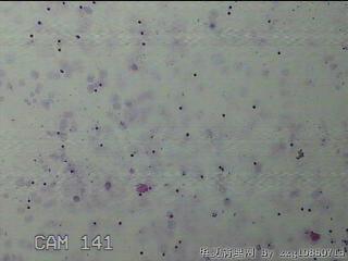 淡黄色胸水5ml图13