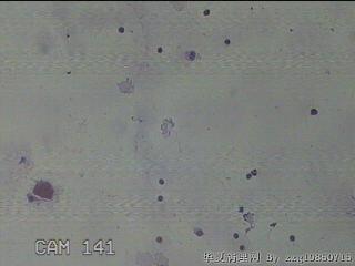 淡黄色胸水5ml图30