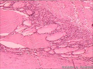 甲状腺肿块图6