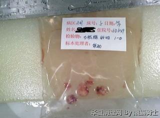 右侧腮腺肿物图1