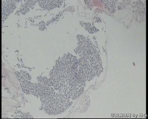 请老师看看！同事父亲支气管镜活检图3