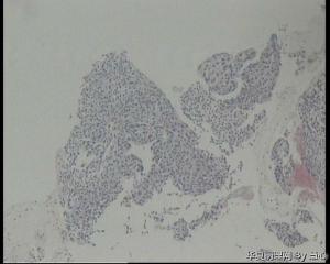 请老师看看！同事父亲支气管镜活检图2