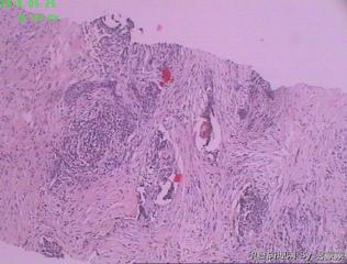 甲状腺右叶结节图8