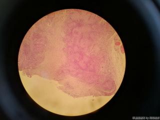 胸壁肿物，乳腺癌？图3