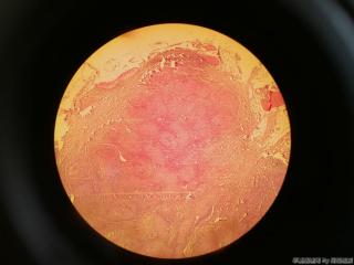 胸壁肿物，乳腺癌？图2