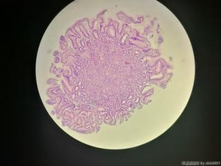 管状腺瘤？貌似不是很典型？图1