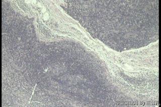 左侧颌面肿物，淋巴结反应性增生吗？图1