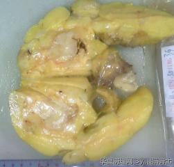 右大腿肿物:脂肪肉瘤？图2