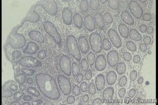 横结肠息肉，腺瘤性息肉吗？图7