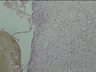 宫颈赘生物图19