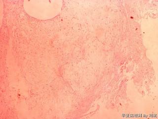 粘液脂肪瘤？图2