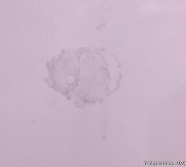 粘液脂肪瘤？图1