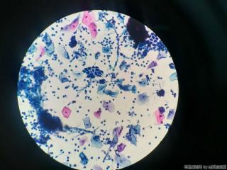 宫颈赘生物，术前TCT图5