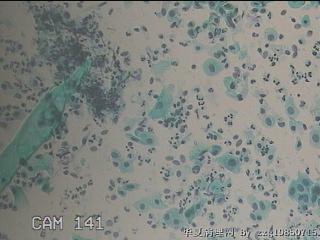 宫颈HPV感染（高危型）图8