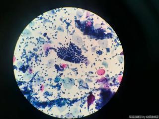 宫颈赘生物，术前TCT图2