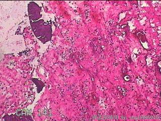双侧鼻腔新生物图18