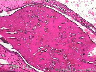 双侧鼻腔新生物图9