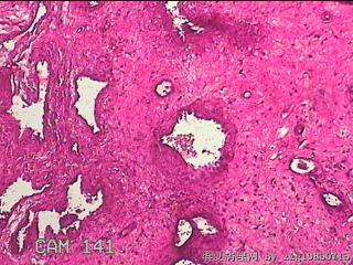双侧鼻腔新生物图17