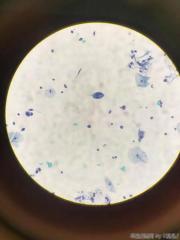 可见非典型林状上皮细胞？图12