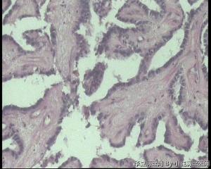 求助，请老师看看甲状腺肿物，乳头状腺癌吧？无明显毛玻璃核图8