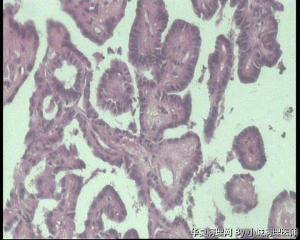 求助，请老师看看甲状腺肿物，乳头状腺癌吧？无明显毛玻璃核图2