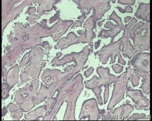 求助，请老师看看甲状腺肿物，乳头状腺癌吧？无明显毛玻璃核图7