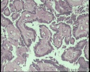 求助，请老师看看甲状腺肿物，乳头状腺癌吧？无明显毛玻璃核图6