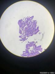 乙状结肠咬检，腺癌？图8