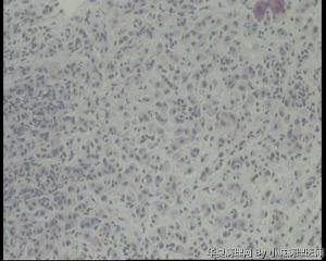 急！求老师看看胃镜活检这些细胞是泡沫细胞吗？还是印戒细胞？图5