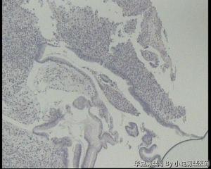 急！求老师看看胃镜活检这些细胞是泡沫细胞吗？还是印戒细胞？图2