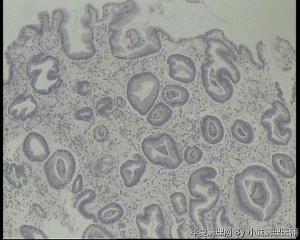 急！求老师看看胃镜活检这些细胞是泡沫细胞吗？还是印戒细胞？图1