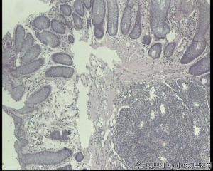 请老师看看，直肠息肉怎么报？图3