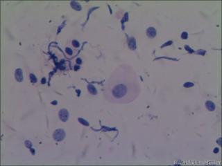 hpv16阳性图4