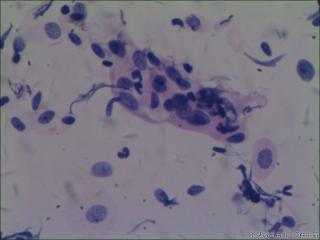 hpv16阳性图3