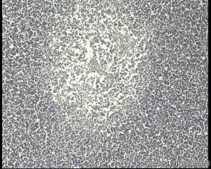 请老师看看，前纵膈占位，胸腺瘤，第一次遇到，是B1型吗？图5