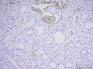 甲状腺病变，求助，临床诊断甲亢图15