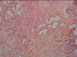 右侧腭部肿物图5