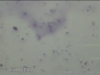 膝关节积液图11