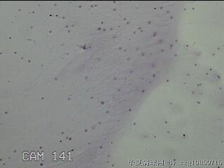 膝关节积液图6