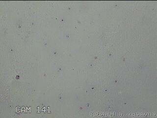 膝关节积液图18
