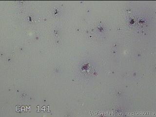 膝关节积液图19