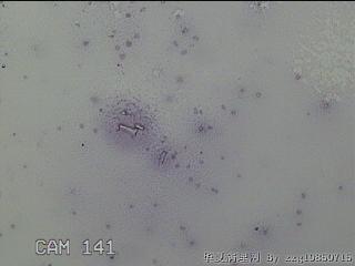 膝关节积液图12